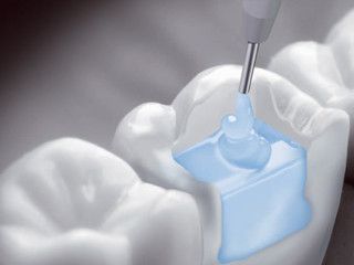 Композит для реставрації бокової групи зубів SDR, Dentsply шпр. 1 гр.